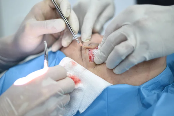 Blefaroplastia Durante Cirugía Cerca Parte Cara Una Mujer Mediana Edad — Foto de Stock