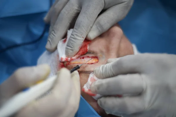 手術クローズアップ中の眼瞼形成術 中年女性の顔の一部 上まぶたと脂肪の余分な皮膚を切り取る手術器具 — ストック写真
