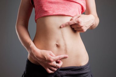 Woman with long abdominal scars after operation clipart