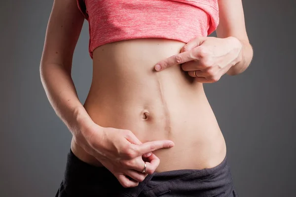 Frau mit langen Narben am Bauch nach Operation — Stockfoto