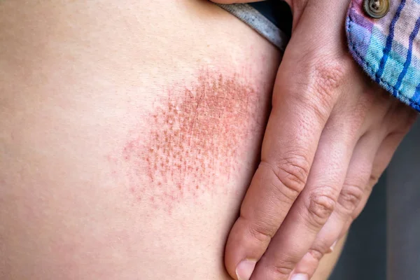 Krassen op de huid van het vallen van fiets. — Stockfoto