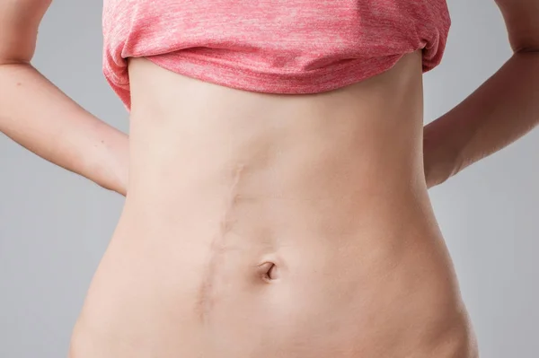 Mujer europea con largas cicatrices abdominales después de la operación —  Fotos de Stock