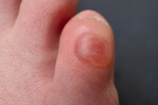 Callus no dedo mindinho depois de usar sapatos desconfortáveis. Vista de perto. — Fotografia de Stock