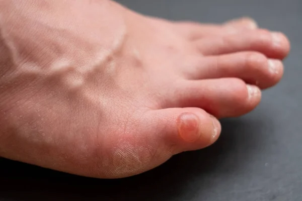 Callus on pinky toe after wearing uncomfortable shoes. Close up view. — Stock Photo, Image