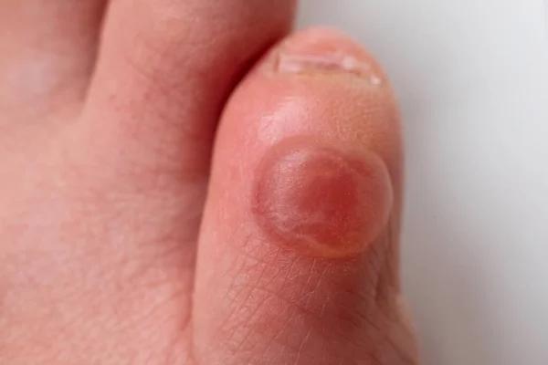 Callus no dedo mindinho depois de usar sapatos desconfortáveis. Vista de perto. — Fotografia de Stock