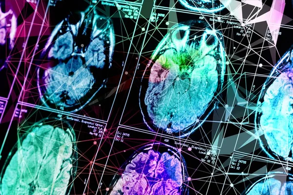 Röntgenbild Des Gehirn Computertomographen — Stockfoto