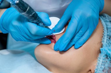 Güzellik uzmanı, dudaklarından kalıcı makyaj uygulanır. Dudak dövme