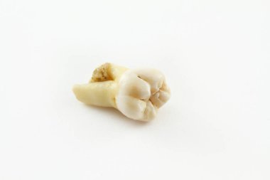 Sekizinci alt diş kemik doku kağıt üzerinde bir parça ile birlikte kaldırıldı. Yirmilik diş