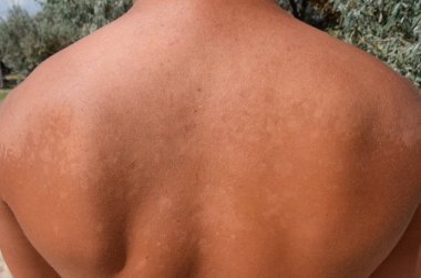 Arka ciltte güneş yanığı. Pul pul dökülme, cilt peeling. Tehlikeli güneş tan.