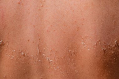 Arka ciltte güneş yanığı. Pul pul dökülme, cilt peeling. Tehlikeli güneş tan.