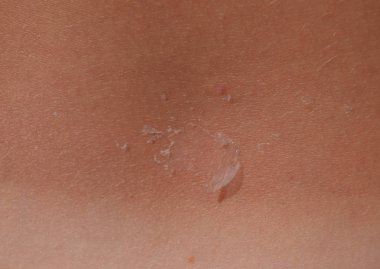 Arka ciltte güneş yanığı. Pul pul dökülme, cilt peeling. Tehlikeli güneş tan.