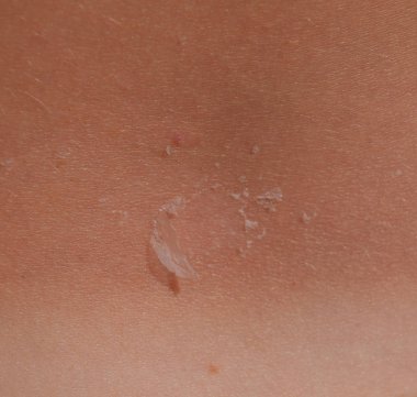 Arka ciltte güneş yanığı. Pul pul dökülme, cilt peeling. Tehlikeli güneş tan.