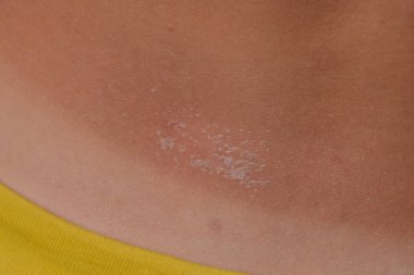 Arka ciltte güneş yanığı. Pul pul dökülme, cilt peeling. Tehlikeli güneş tan.