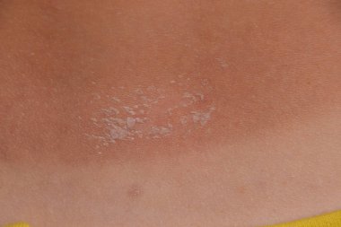 Arka ciltte güneş yanığı. Pul pul dökülme, cilt peeling. Tehlikeli güneş tan.