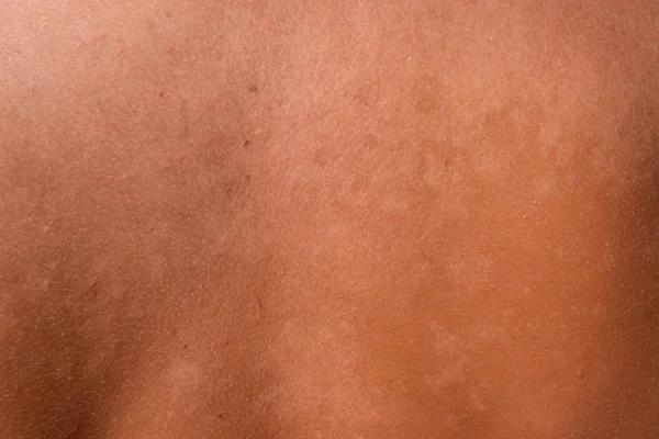 Ηλιακό Έγκαυμα Στο Δέρμα Της Πλάτης Απολέπιση Δέρμα Ξεφλουδίζει Μακριά — Φωτογραφία Αρχείου