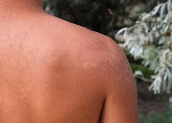 背中の皮膚に日焼け 皮膚がはがれます 危険な日焼け — ストック写真