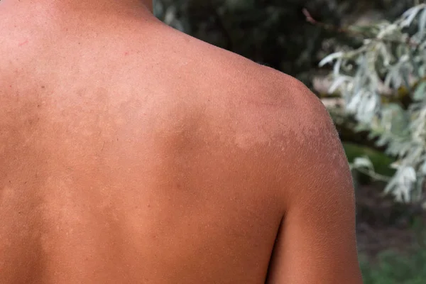 Quemaduras Solares Piel Espalda Exfoliación Piel Desprende Peligroso Bronceado — Foto de Stock