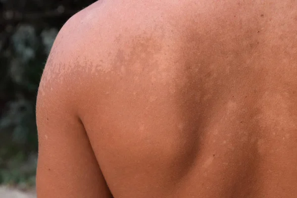 Coups Soleil Sur Peau Dos Exfoliation Peau Décollée Bronzage Dangereux — Photo