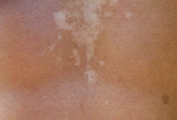 Quemaduras Solares Piel Espalda Exfoliación Piel Desprende Peligroso Bronceado — Foto de Stock