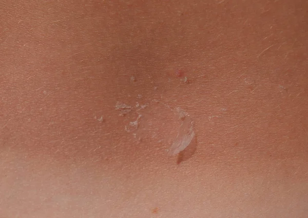 背中の皮膚に日焼け 皮膚がはがれます 危険な日焼け — ストック写真