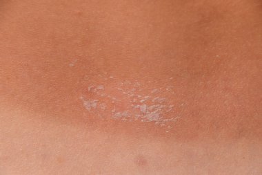 Arka ciltte güneş yanığı. Pul pul dökülme, cilt peeling. Tehlikeli güneş tan.