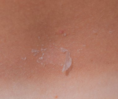 Arka ciltte güneş yanığı. Pul pul dökülme, cilt peeling. Tehlikeli güneş tan.