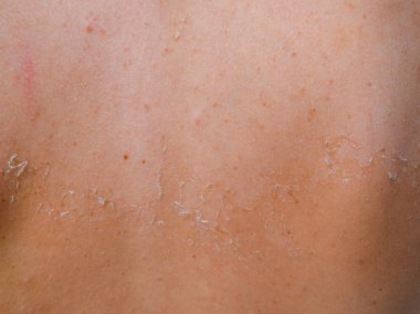 Arka ciltte güneş yanığı. Pul pul dökülme, cilt peeling. Tehlikeli güneş tan.
