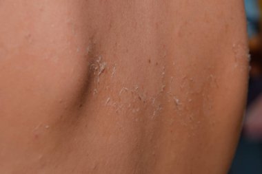 Arka ciltte güneş yanığı. Pul pul dökülme, cilt peeling. Tehlikeli güneş tan.