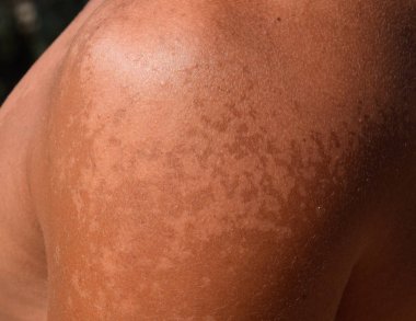 Omuz cilt üzerinde güneş yanığı. Pul pul dökülme, cilt peeling. Tehlikeli güneş tan.