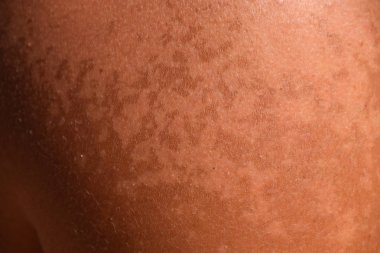 Omuz cilt üzerinde güneş yanığı. Pul pul dökülme, cilt peeling. Tehlikeli güneş tan.