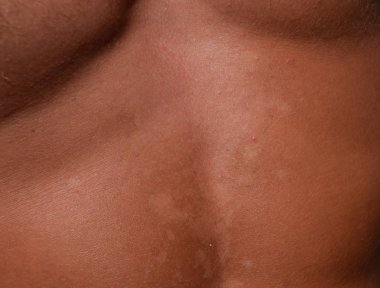 Mide cilt üzerinde güneş yanığı. Pul pul dökülme, cilt peeling. Tehlikeli güneş tan.