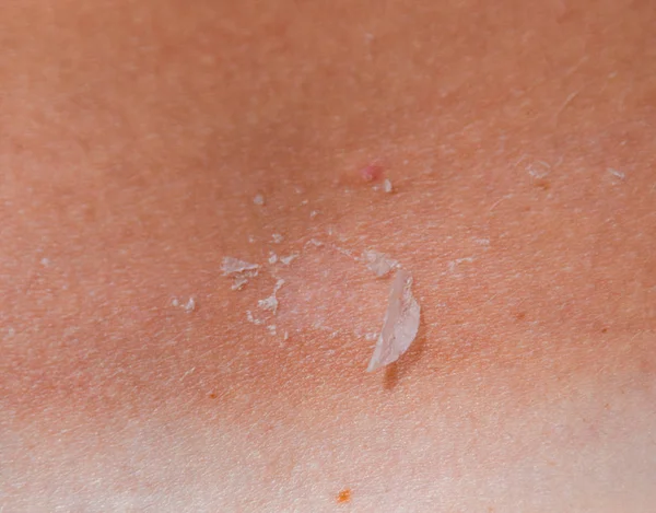 Sonnenbrand Auf Der Haut Des Rückens Peeling Die Haut Blättert — Stockfoto