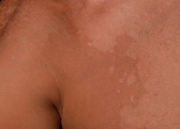 Сонячний Опік Шкірі Плечей Відшарування Шкіра Відшаровується Небезпечний Сонячний Засмага — стокове фото