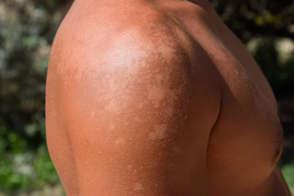 Omuz Cilt Üzerinde Güneş Yanığı Pul Pul Dökülme Cilt Peeling — Stok fotoğraf