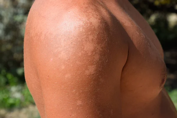 Ηλιακό Έγκαυμα Στο Δέρμα Των Ώμων Απολέπιση Δέρμα Ξεφλουδίζει Μακριά — Φωτογραφία Αρχείου