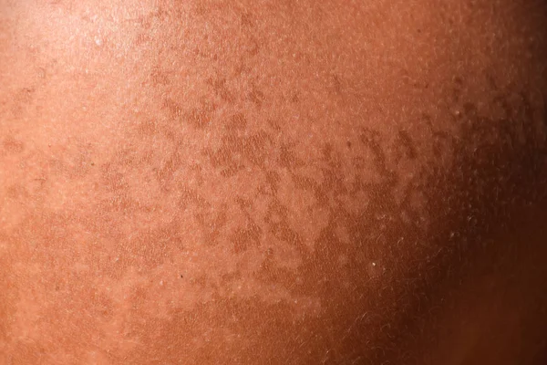 Quemaduras Solares Piel Los Hombros Exfoliación Piel Desprende Peligroso Bronceado — Foto de Stock