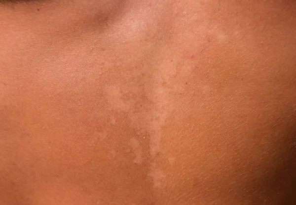 Quemaduras Solares Piel Del Estómago Exfoliación Piel Desprende Peligroso Bronceado — Foto de Stock