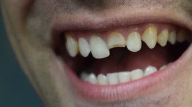 Kırık diş. Üst kesici bir adam ağzına kırık. Adam ağız boşluğu dişçiye gösterir. Kırık bir diş tedavisi.