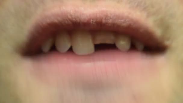 Zlomený Zub Nefunkční Horní Řezák Ústech Muže Muž Ukazuje Zubaři — Stock video