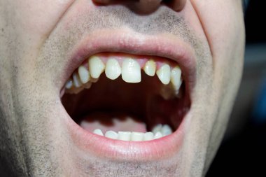 Bir diş değiştirme işlemi. Diş taç altında hazırlanması. Dişin içinde toplu iğne