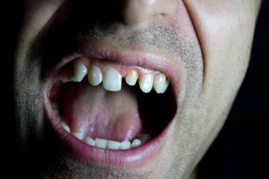 Bir diş değiştirme işlemi. Diş taç altında hazırlanması. Dişin içinde toplu iğne