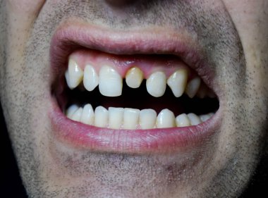 Bir diş değiştirme işlemi. Diş taç altında hazırlanması. Dişin içinde toplu iğne