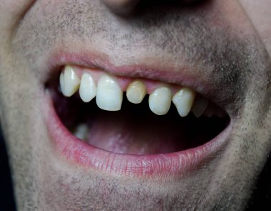 Bir diş değiştirme işlemi. Diş taç altında hazırlanması. Dişin içinde toplu iğne