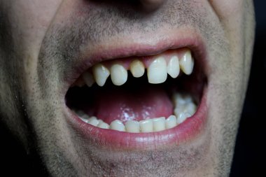 Bir diş değiştirme işlemi. Diş taç altında hazırlanması. Dişin içinde toplu iğne