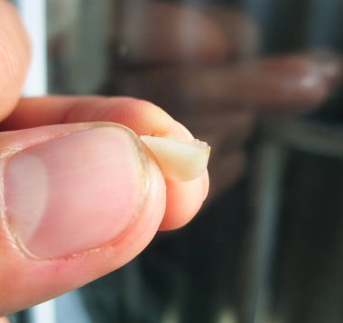 Yaşlı bir kesici ile doldurma düşmüş. Diş ve mühür