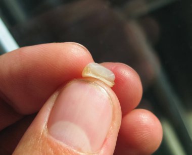 Yaşlı bir kesici ile doldurma düşmüş. Diş ve mühür