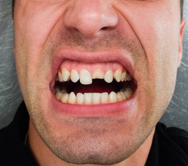 Kırık diş. Üst kesici bir adam ağzına kırık. Adam ağız boşluğu dişçiye gösterir. Kırık bir diş tedavisi.