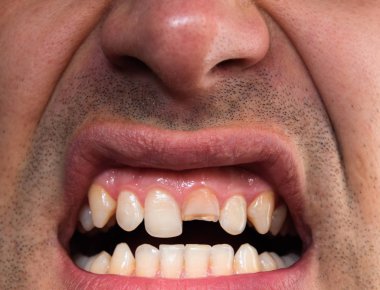 Kırık diş. Üst kesici bir adam ağzına kırık. Adam ağız boşluğu dişçiye gösterir. Kırık bir diş tedavisi.