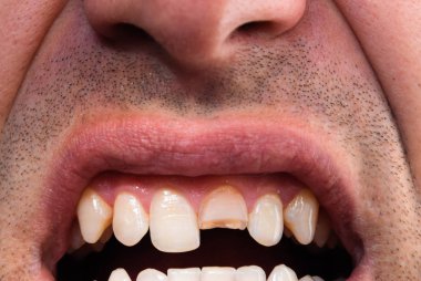 Kırık diş. Üst kesici bir adam ağzına kırık. Adam ağız boşluğu dişçiye gösterir. Kırık bir diş tedavisi.