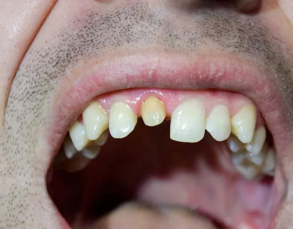 歯を取り替えるプロセス 歯冠の下の準備 歯を固定します — ストック写真